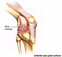 Изменения в коленном суставе при остеоартрозе